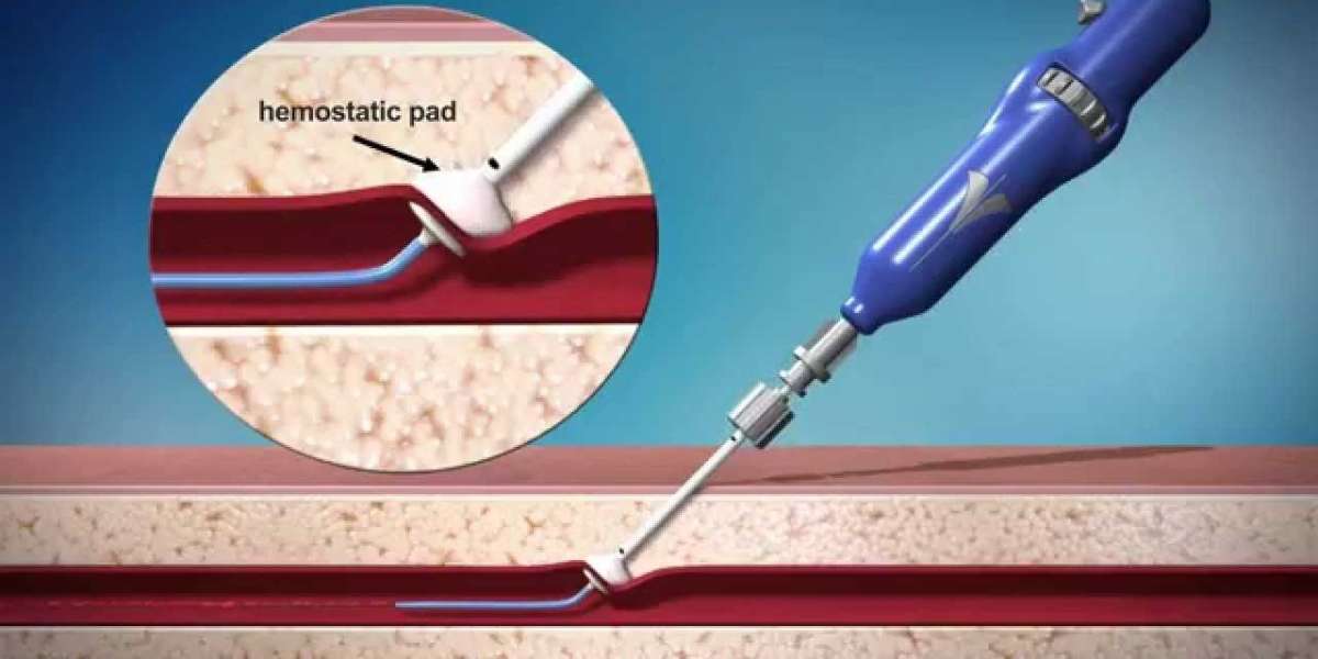 Vascular Closure Devices Market Revenue is poised to reach USD 1.3 billion by 2026