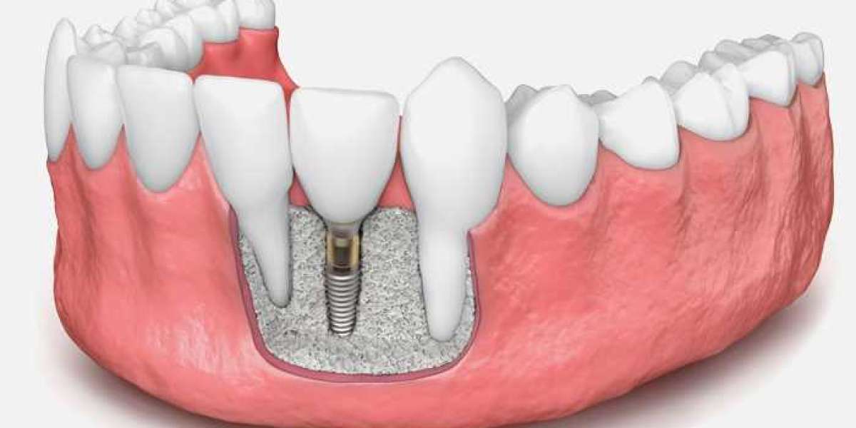 Emerging Trends in the Dental Bone Graft Substitute Industry